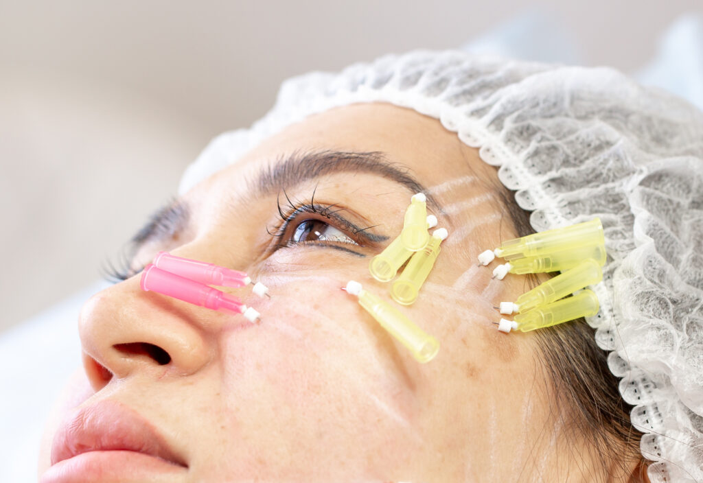 Thread lifting is a cosmetological procedure for face rejuvenation. The aesthetician implants PDO threads under the skin to relieve wrinkles and skin laxity