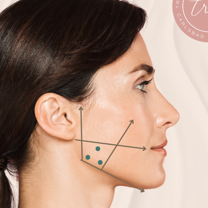 woman's side profile with diagram of precision placement of botox for the masseters